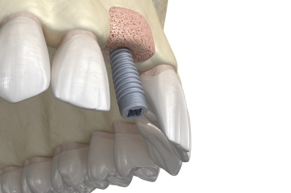 Animated dental implant in upper jaw after dental bone grafting in Clute