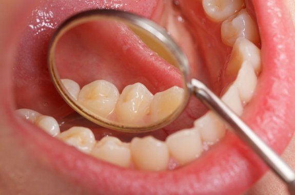 Close up of dental mirror inside of mouth