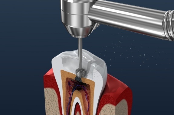 Animated dental tool performing root canal treatment