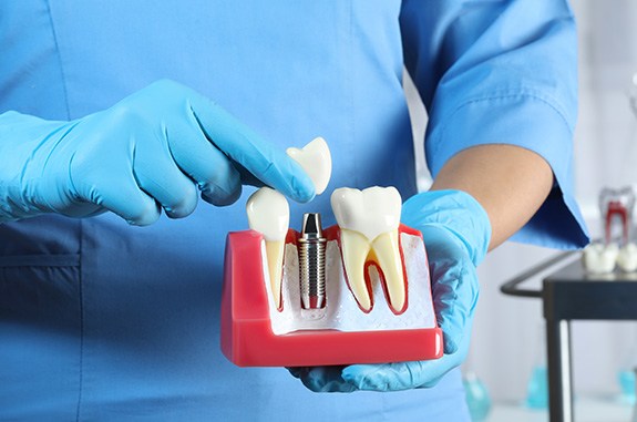 a dentist holding a dental implant model