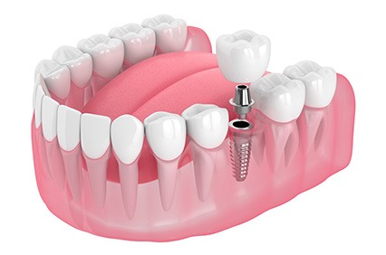 a 3d illustration of dental implant placement